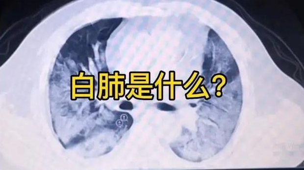 白肺是可以治愈的吗，白肺可以治愈吗？