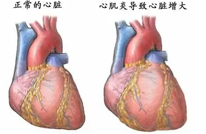 怎么判断自己得了心肌炎，心肌炎的自判方法