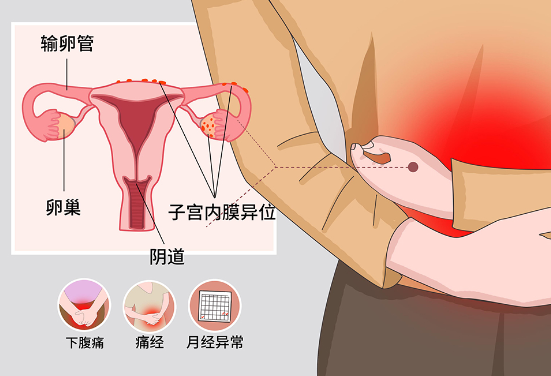 子宫内膜异位症，什么是子宫内膜异位症，子宫内膜异位症有哪些症状