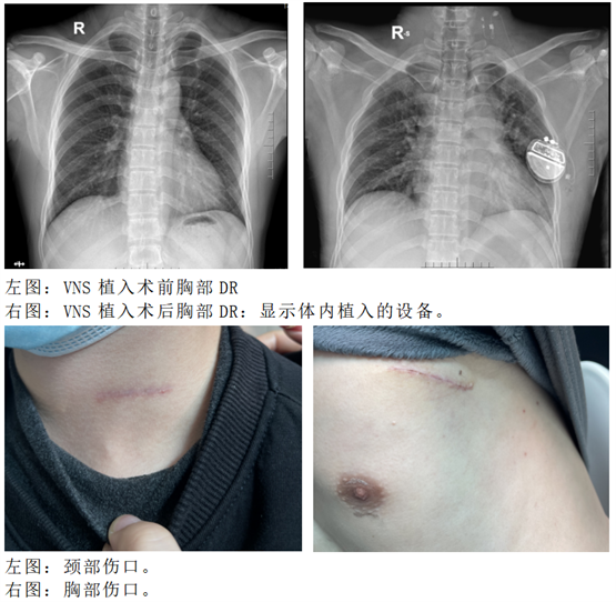 药物难治性癫痫患者体内植入新型抗癫痫电子药，控制癫痫发作