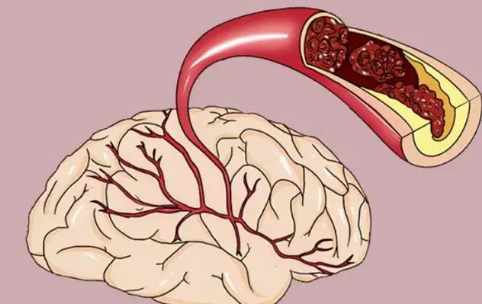 脑供血不足症状表现有哪些（脑供血不足的症状）
