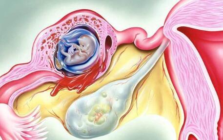 宫外怀孕怎么处理（宫外怀孕怎么处理胎儿）