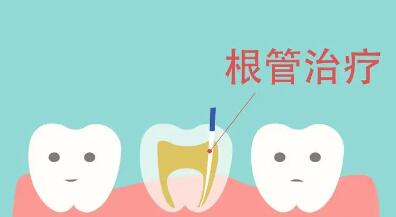 根管治疗多少钱一颗牙（根管治疗多少钱一颗牙加全瓷）