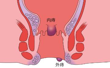 痔疮是什么样子的（痔疮是什么样子的外疮）