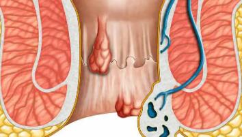 肛门口有个肉球突出是怎么回事